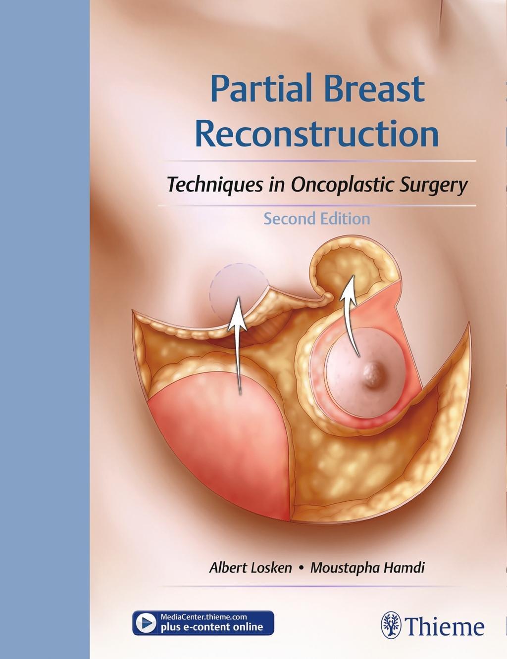 Thumbnail - Partial Breast Reconstruction Albert Losken