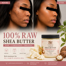 Natural Eczema Relief Cream Organic Raw Shea Butter Psoriasis Dry Skin Balm 4oz