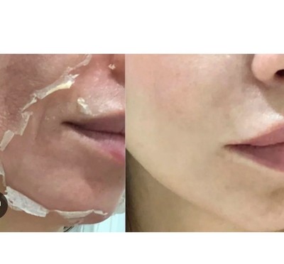 30% TA Chemical Skin Peeling Solution 30ml Glass Amber Dropper Bottle