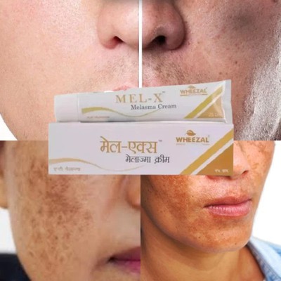 Wheezal Mel-X Melasma Creme Melasma, Chloasma und vorzeitige Alterung (25g)