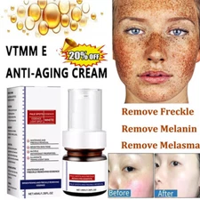 Effective Whitening Freckle Cream Remove Dark Spot Cream Removal Melanin Melasma