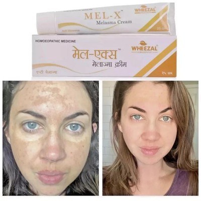 Wheezal Mel-X Melasma Cream (25g) melasma, chloasma, and premature aging