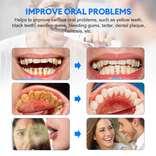 Escalador dental ultrasónico limpiador blanqueador de dientes removedor de cálculo de placa de sarro - Imagen 12 de 18