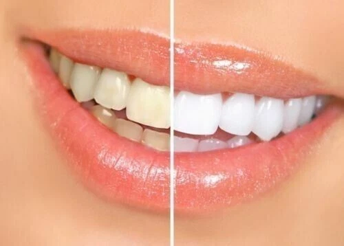Teeth Whitening Strips 5D professional bleaching 2 weeks supply Enamel Safe UK - Picture 7 of 7