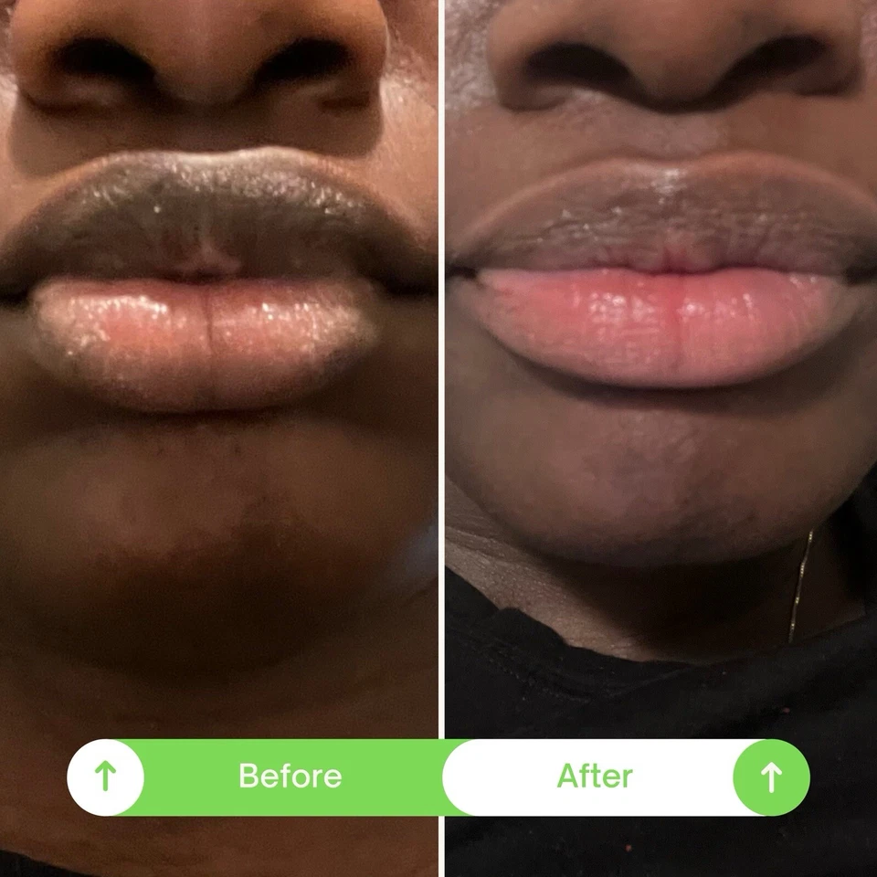 ULTRAFAST! Lip lightening balm for dark lips/smokerlips (Men and Women) - Image 4 of 4