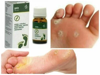 GALA PHARM UK STOCK Remove CALLUSES CORNS & WARTS With Gala Foot & Skin Care LACTIC Acid