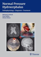 Normal Pressure Hydrocephalus Michael J. Fritsch