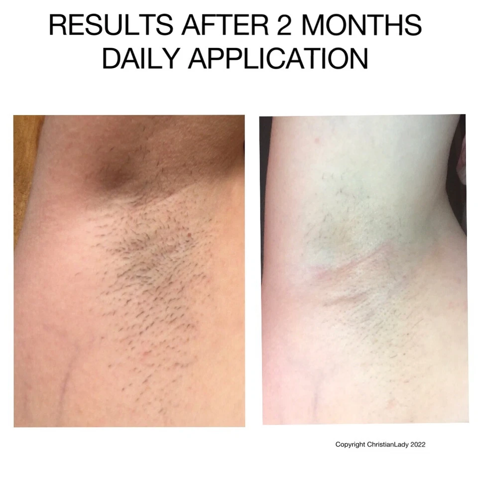 Reducción permanente del vello/depilación-espalda, piernas, pecho-unisex-cara/cuerpo Foto 2 de 4