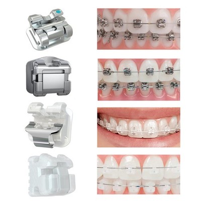Orthodontic Metal Brackets Clever M Thomas Ceramic Damon AO Empower Interactive