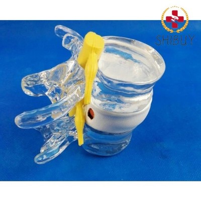 Anatomical Human Lumbar Vertebrae Skeleton Anatomy Degenerative Model