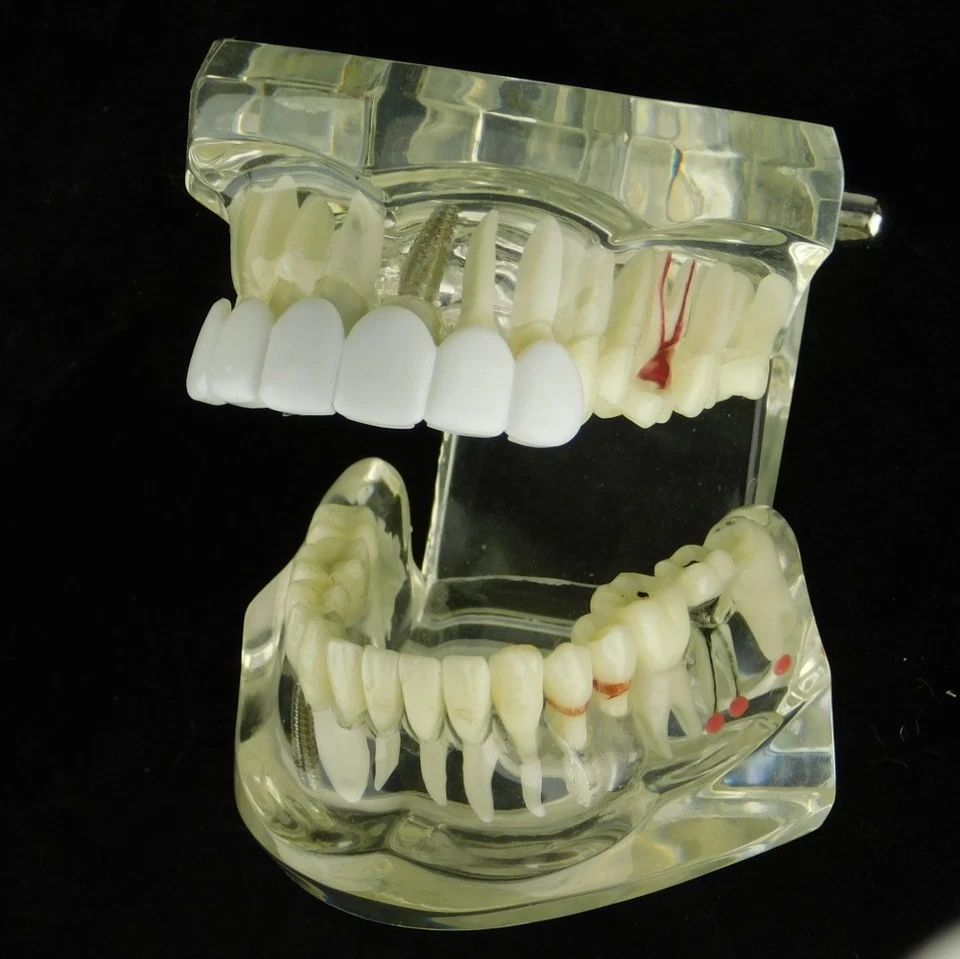 Men's White Teeth Grillz Top 6 Teeth Bright Smile Pre-Made Instant Mouth Grills - Image 4 of 4