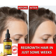Hair Regrowth For Men Women Natural Oil Serum Grow Loss Treatment Ginger Oil