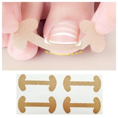 VIVI'S COLLECTION 20 Toenail Correction Patch Straightener Nail Toe Ingrown Paronychia Stickers