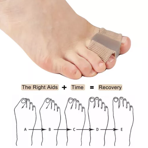 1PCS Bunion Corrector Toe Splint Straightener Hallux Valgus Foot Separator - Picture 10 of 12
