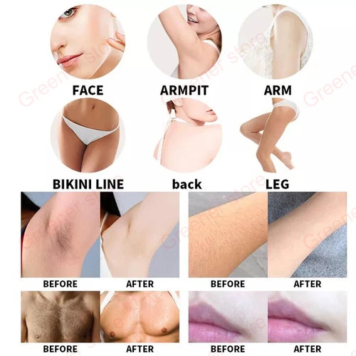 2IN1 Ice Titanium 755nm 808nm 1064nm Diode Laser Full Body Hair Removal Machine - Picture 11 of 13