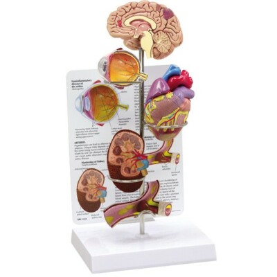 Hypertension 4-pc Organ Set GPI AnatomyModel  LFA#4000 Make Us an OfferSEE VIDEO