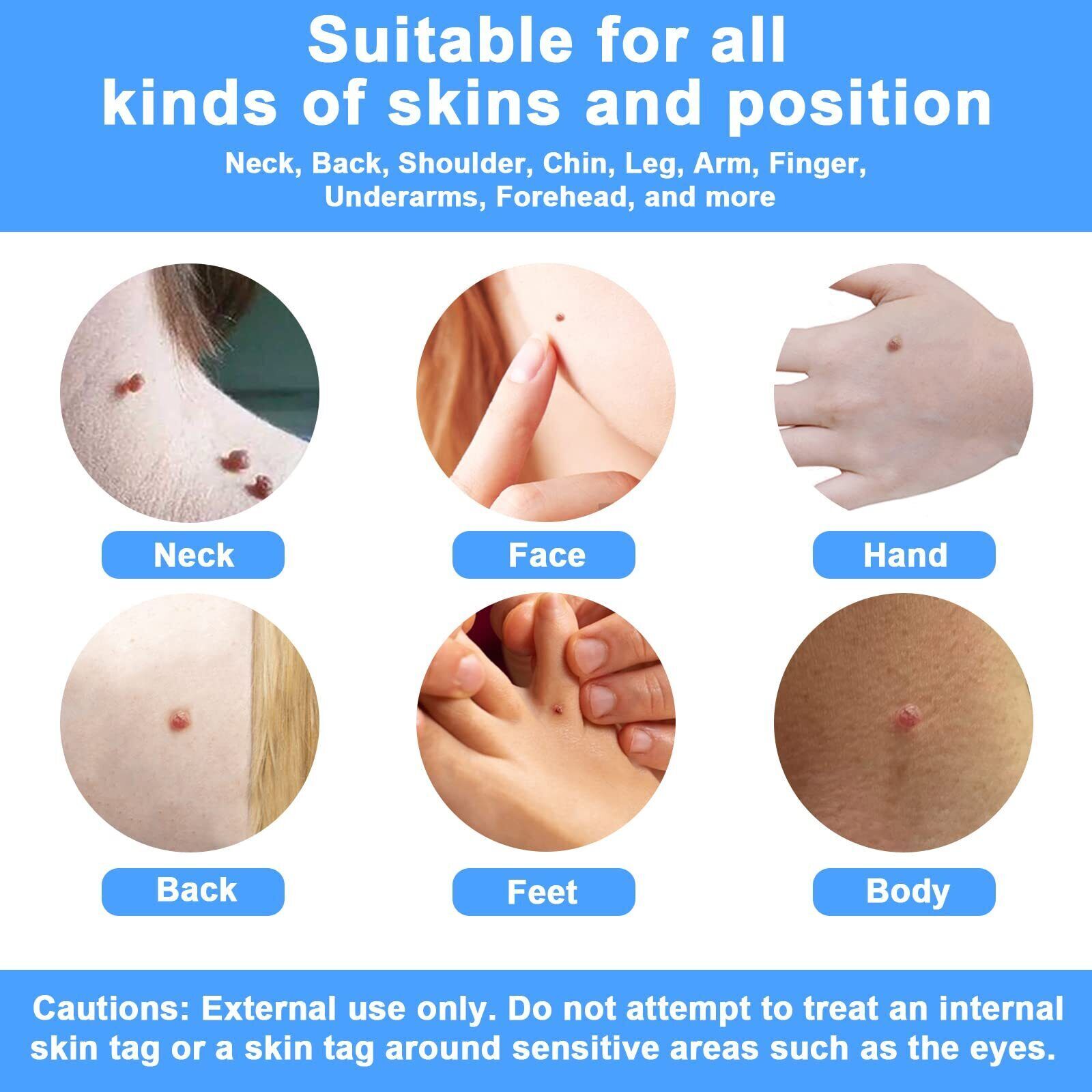 Auto Micro Skin Tag Remover Device Kit Safe Painless Removal 28 mm