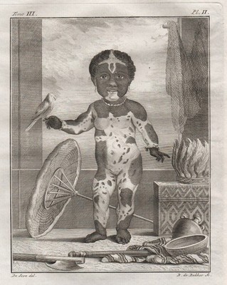 Child Kind medical abourmity Kupferstich engraving gravure Buffon 1780