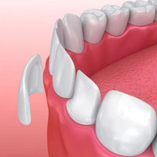【Product sample】【Ceramic Composite Veneers】 - Natural Look - Easy Bonding