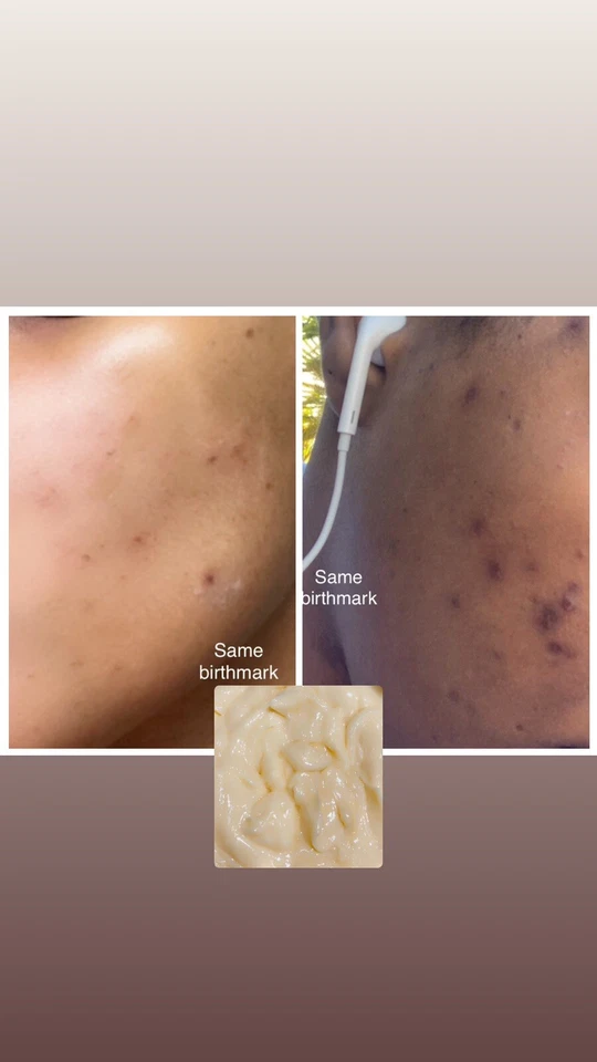 Dark Spot, Black Spot, Face Brightening, Pimples, Age Spots Rice & Egg Yolk FC. - Image 4 of 4