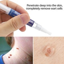 5ML Skin Tag  Wart Remover Pen Painless Removes Common Plantar Warts Foot Corns