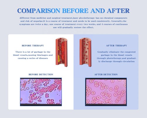Cold Laser Therapy Device High Blood Pressure Treatment Machine Gift for Elderly - Picture 4 of 6