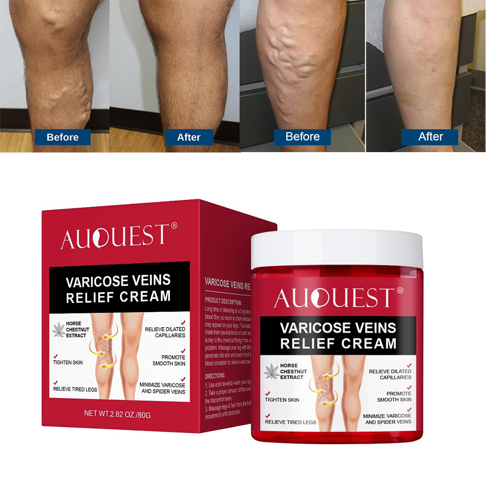 Varicose Veins Relief Cream Relieve Tired Legs Spider Pain Tighten Smooth  Skin | eBay