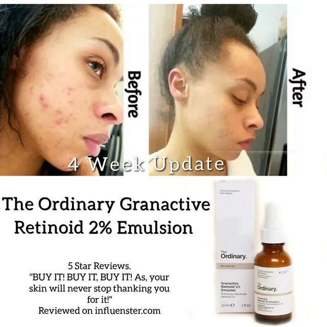 granactive retinoid acne