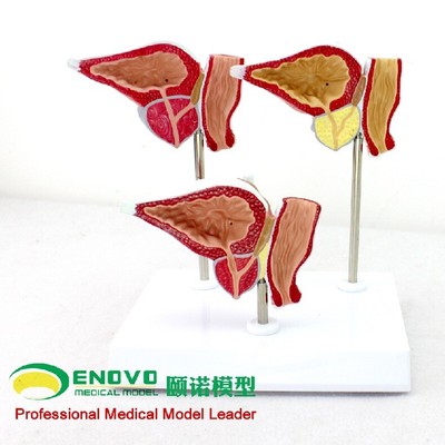 Normal and Diseased Prostate Gland Genitourinary Medical Anatomical Model