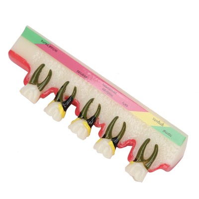 Dental PerioURStal Disease Model Tooth Disease Study Teaching Model For Dent URS