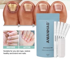 Anti Fungal Nail Treatment Pen | Swiss Formula for Fungus Repair, 5-Pack