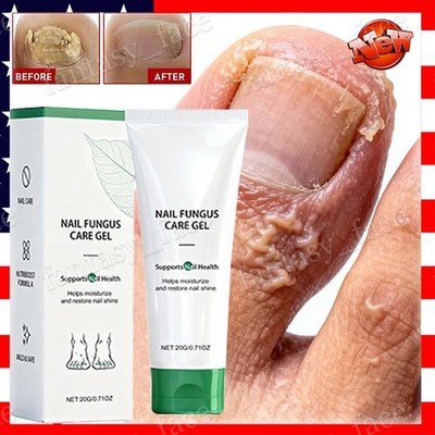 Nutraboost Nail Fungus Treatment Gel, Nail Fungus, Fungus Cream (1PCS)