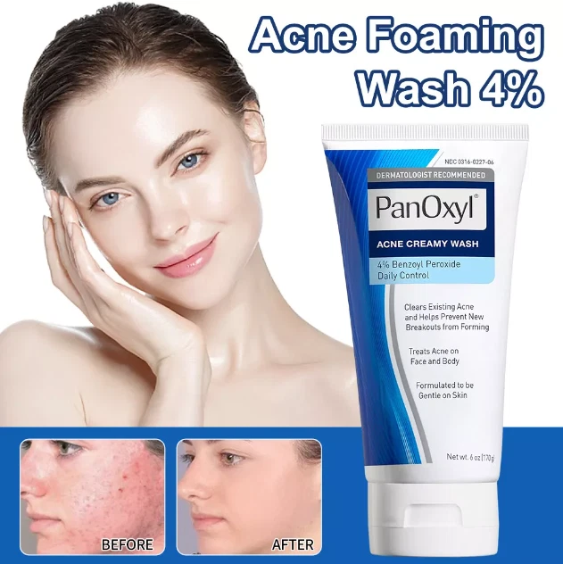 Acne Foaming Wash Face & Body 4% Active Ingredient 170g New UK Moisture