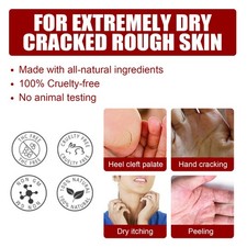 Deep Exfoliating Glycolic Acid Foot Peel for Callus Removal and Skin Hydration