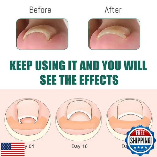 Ingrown Toenail Treatment, 60Pcs Breathable Ingrown Toenail Strips, Professio - Picture 4 of 5