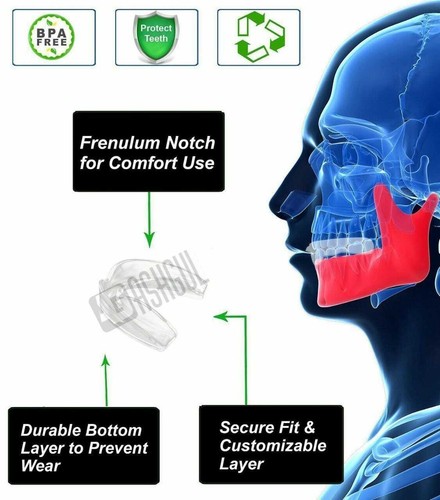 3PCS STRESS GUARD Mouth Teeth Tooth Grinding Clenching Bruxism Night Sleep Guard - Picture 3 of 8