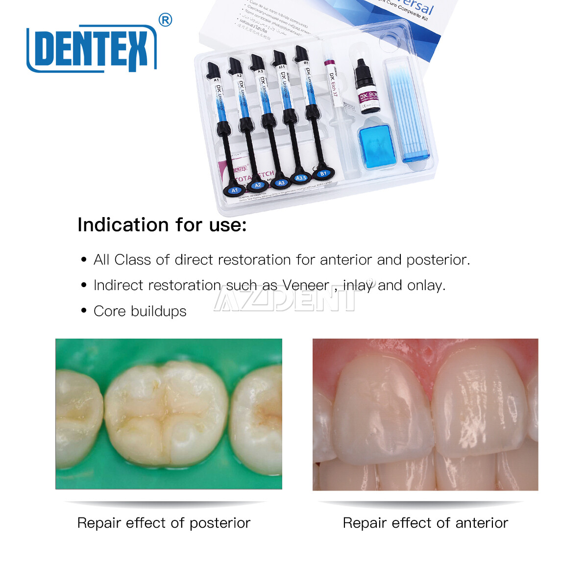 Dentex Dental Light Cure Hybrid Resin Composite  Restoration 6 Syring Kit A1-B1