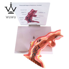 Human Esophageal Model Human Esophageal Polyp Erosion Anatomical Model