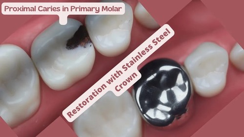 3M Espe SS Crown Primary Molar Crown-D ( 1st molar) frre ship - Picture 4 of 8