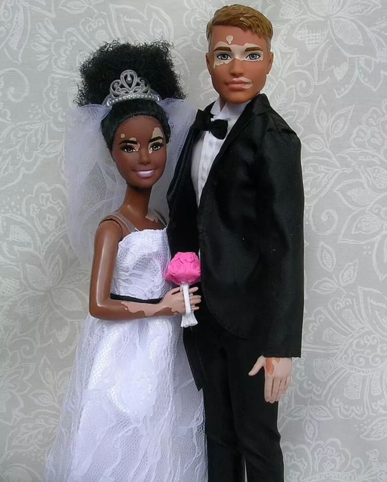 Barbie vitiligo hot sale