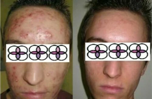 10-20-30-40-50-60-70% Glycolic Acid Night Cream 2oz/ 60ml Aging/Acne/scar - Image 3 of 4