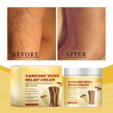 Leg Varicose Veins Relief Cream Improves Leg Fatigue and Venous Circulation