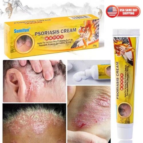 Crema para el cuidado de la salud psoriasis eccema pomada cuero cabelludo psoriasis mano tiña pie   - Imagen 1 de 7