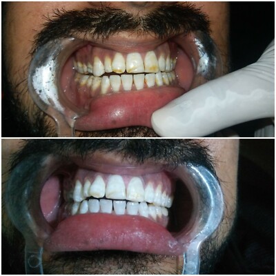 Blanqueador De Dientes Laser Gel KIT Profesional Dientes Blanqueamiento Dental