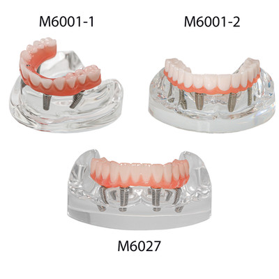 US Dental Overdenture All-on-4/6 Upper/Lower Jaw Teeth Model with 4/6 Screws