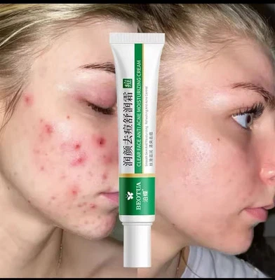 1pc Effective Acne Removal Cream Acne Treatment Skin Whitening Pimple Acne Cream