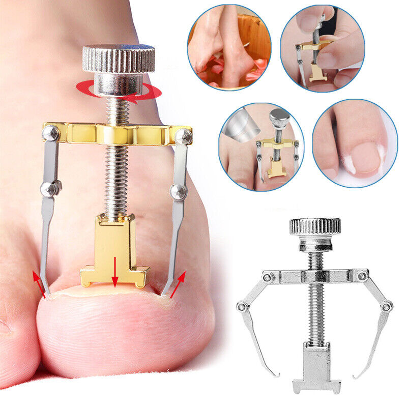 Ingrown Toe Nail Corrector Tool Ingrowing Toe Nail Clamp Straightener Feet  Foot | eBay