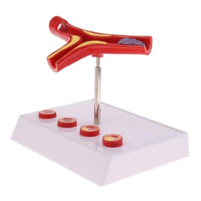 Atherosclerosis Human Vessel Statue 50X Extension Study