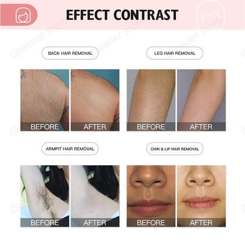 Diode Laser 3 Waves 755nm 808nm 1064nm Permanent Hair Removal Machine Painless - Picture 3 of 12