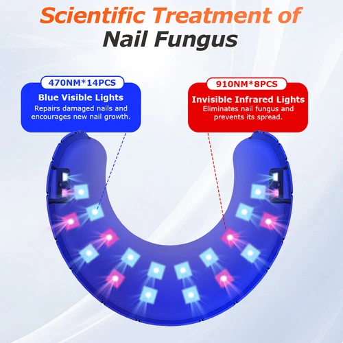 Non-invasive Laser For Thick Toenails Pain-free Toenail Treatment Fungus Removal - Bild 9 von 29